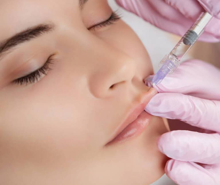 A woman received a lip filler injection.