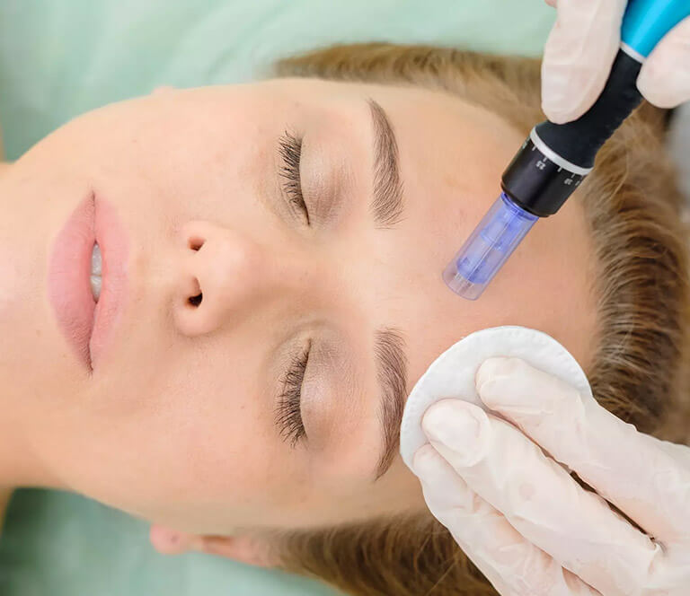 Close up of a woman receiving microneedle treatment.