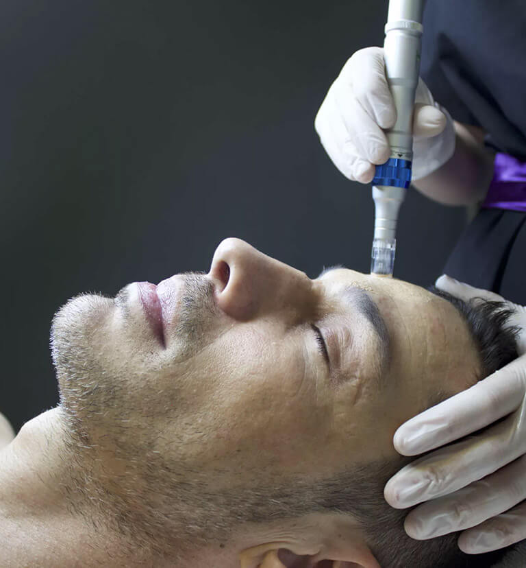 Man receiving microneedling treatment.